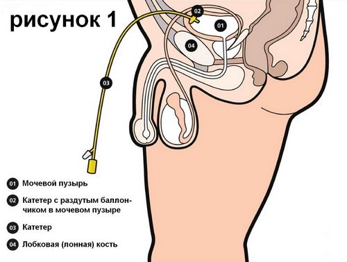 При цистоме мочевой пузырь промывают