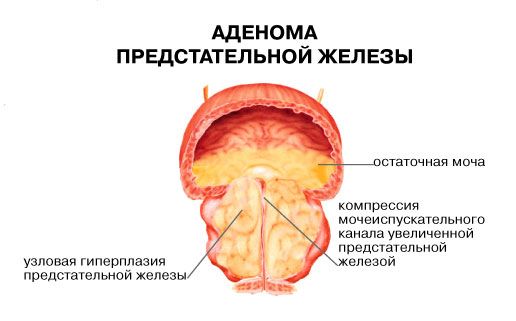 Цистостома мочевого пузыря у мужчин при раке предстательной железы