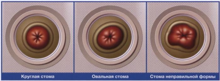 что такое фланец в калоприемнике. Смотреть фото что такое фланец в калоприемнике. Смотреть картинку что такое фланец в калоприемнике. Картинка про что такое фланец в калоприемнике. Фото что такое фланец в калоприемнике